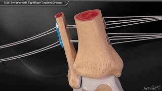 Dual Syndesmosis TightRope Implant System [upl. by Frymire]