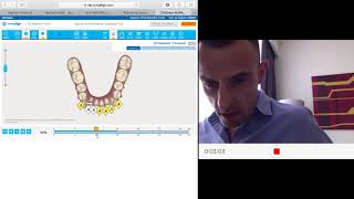 Invisalign Clincheck Deepbite and severe crowding [upl. by Nairde]