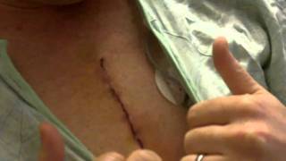 Day 3 recovery from open heart surgery to replace aortic val [upl. by Ardried]