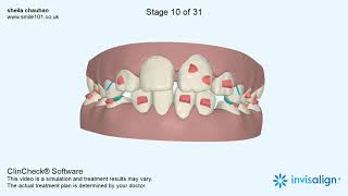 Invisalign first clincheck [upl. by Dace]