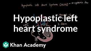 Hypoplastic left heart syndrome and norwood glenn fontan  NCLEXRN  Khan Academy [upl. by Aicineohp276]