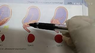 Antepartum haemorrhage EASY LEARNING [upl. by Enej]