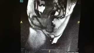 Magnetic Resonance Defecography Rectocele Cystocele [upl. by Keller224]