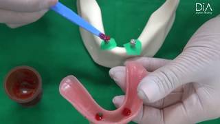 Dental Implant education video overdenture part [upl. by Castra]