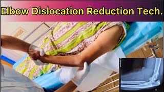 Elbow Dislocation Reduction How to Reduce Posterior Dislocation Elbow with patient in Supine positn [upl. by Aynuat]