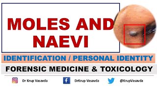 Moles and Naevi  Identification  Dr Krup Vasavda [upl. by Begga113]