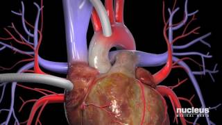 Coronary Artery Bypass Graft  Understanding Cardiovascular Disease [upl. by Erskine124]