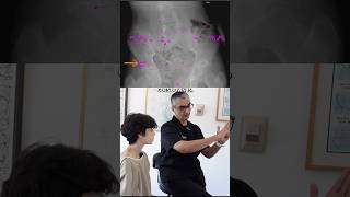 9 Years Limping and SEVERE Back Pain  Coccyx amp Pelvis Adjustment shorts [upl. by Kappenne]