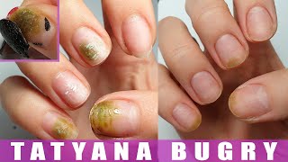 How I Cured My Nails  Shocking Experience  Restoring Nails from Bacteria [upl. by Enirrok]