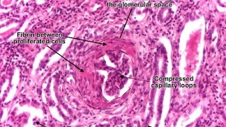 Rapidly Progressive Glomerulonephritis RPGN [upl. by Hgielyk]