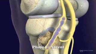 Peroneal and Tibial Intraneural Ganglion Cysts in the Knee Region Video 1 [upl. by Oeram902]