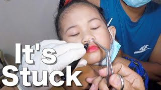 Foreign Body Stuck In Girls Nose Removal  What is it [upl. by Meda]