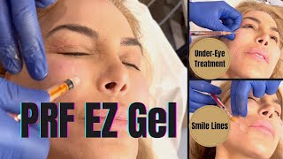 PRF EZ Gel Plasma Undereye and Smile Line Treatment prf [upl. by Ahsenahs]