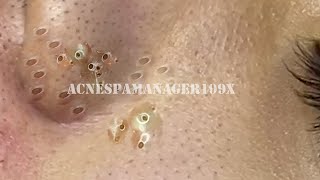 Blackhead Removal With Sac Dep Spa [upl. by Buonomo]