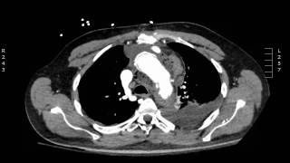 Acute Aortic Dissection CT Axial JETem 2017 [upl. by Odradlig]