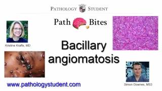 Path Bites  Bacillary angiomatosis [upl. by Nalani]