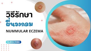 โรคผื่นวงกลม Nummular eczema เกิดจากอะไร รักษาอย่างไร  หมอยาพาคุย [upl. by Atteirneh]