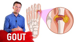 The 7 Natural Remedies for Gout [upl. by Merrili930]