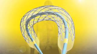 Resolute Integrity Coronary Stent System [upl. by Uhayile665]