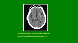 Neurology Quiz 84 Diabetic Striatopathy [upl. by Ahsie]