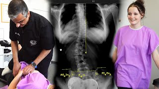 Scoliosis Evaluation For A Back Brace Headaches amp Back Pain Helped ​ Part 4 [upl. by Joly]