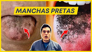 Língua com manchas pretas O que pode ser [upl. by Notsniw346]