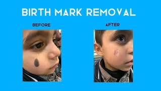 See the Shift Birthmark Removal Journey  Before and After Laser lasertherapy birthmarkremoval [upl. by Fradin821]