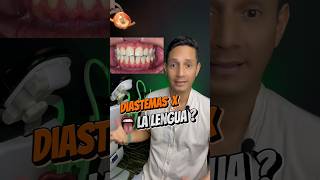 Diastemas por culpa de la LEMGUA 😛 brackets ortodoncia diastema [upl. by Alegnatal]