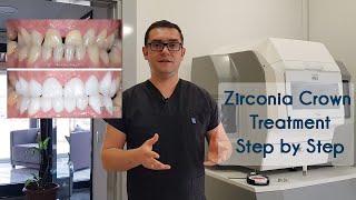 Zirconia Crown Treatment in Turkey amp How We Produce Zirconia Crowns in Elit Dental Clinic Kusadasi [upl. by Aseuqram627]