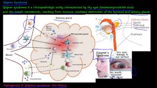 101P  What is Sjögren Syndrome [upl. by Froehlich86]