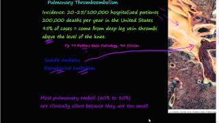 58PEtiology of Pulmonary embolism Saddle embolus Paradoxial embolism [upl. by Ferreby]