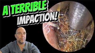 A TERRIBLE IMPACTION 291 ear earwax earwaxremoval foryou asmr asmrearwax satisfying [upl. by Kotto]