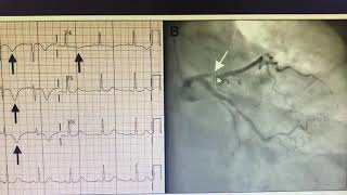 Wellens syndrome [upl. by Idnek]