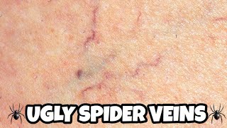 Sclerotherapy for the treatment of Spider Veins [upl. by Yenittirb]