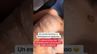 Mastopexiaplasticsurgery cirugiaplasticasegura youtubeshorts mujeres cirugiasplasticas [upl. by Yort]