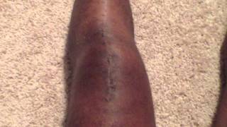 Week 3 Of Recovery of Ruptured Patella Knee Tendon [upl. by Aneleve]