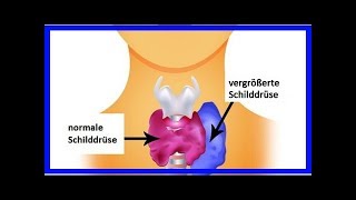 Hyperthyreose bei Frauen Symptome und empfohlene Nahrungsmittel [upl. by Laundes586]