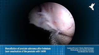 Morcellation of prostate adenoma after holmium laser enucleation of the prostate [upl. by Paton]