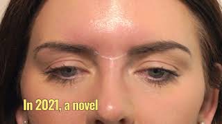 HowTo Treat The Glabella With Botox  3 Point Injecting Technique  Dr Chris Hutton [upl. by Ellennad801]