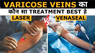 Laser vs Venaseal For Varicose Veins  in Hindi  Dr Gaurav Gangwani [upl. by Fogel]