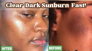 How to FIX Sunburn Fast Sunburn Treatment For Black Skin [upl. by Federica]