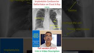 Implantable Cardioverter Defibrillator on Chest XRay [upl. by Waterer777]