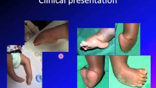 clubfoot  talipes equinovarus  TEV [upl. by Anyt]