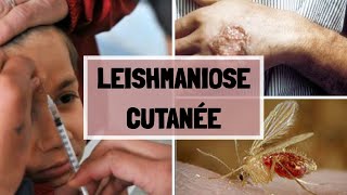 LA LEISHMANIOSE CUTANNÉ  CAUSES  SYPMTOMES  COMPLICATIONS  TRAITEMENT [upl. by Adara102]