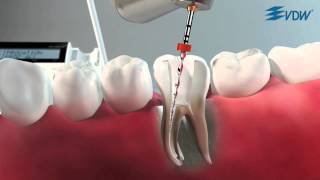 VDW Dental · How To RECIPROC  Retratamiento con RECIPROC R25 ES [upl. by Broadbent]