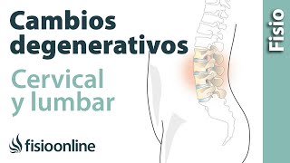 Cambios degenerativos lumbares o cervicales  ¿Qué es [upl. by Ecnerwal]