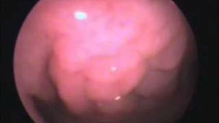 Enlarged adrenoids seen by fibre optic laryngo pharyngo laryngoscopy [upl. by Alexio]