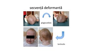 Secvența deformantă torticolis plagiocefalie [upl. by Alenairam]