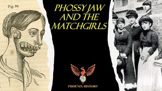 Phossy Jaw And The Matchgirls [upl. by Thgiled]