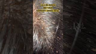 Lice treatment Chennaihow to remove lice from hairanti lice removallice removalhow to treat lice [upl. by Larrej]